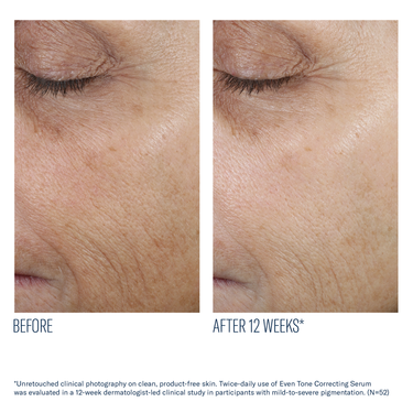 Skin Better Even Tone Correcting Serum, Improve Skin Tone, Reduce Sun Damage - 50ml, 1.7oz, 160 USD