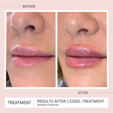 Filler + Toxin Bundle Renew