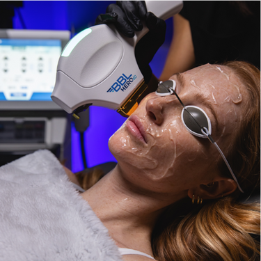 Moxi + BBL Herioc Laser Face+ Neck + Chest SINGLE Renew