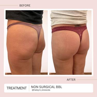 Non Surgical Brazilian Butt Lift renew