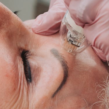 Vivace 3 Sessions + Free Neck Renew